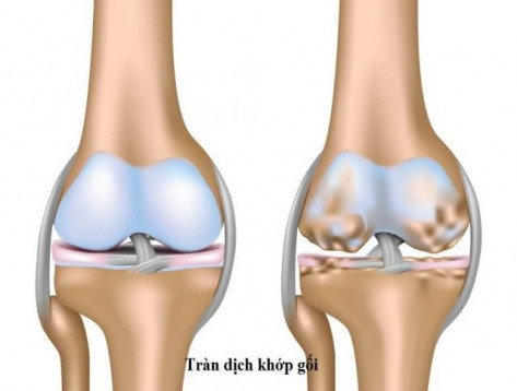 Ngâm Chân Giảm Đau Viêm Khớp Gối – Bí Quyết Dân Gian Người Mường