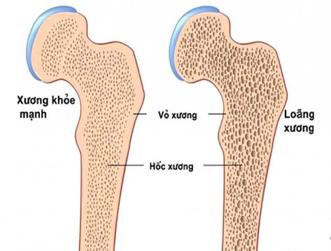 Cẩm nang sức khỏe: Phòng ngừa và cải thiện loãng xương hiệu quả